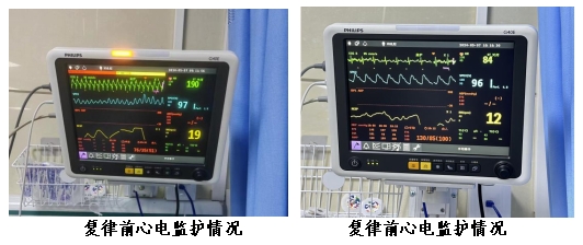 67生死"室"速同步电复律紧急恢复顽固性室速患者